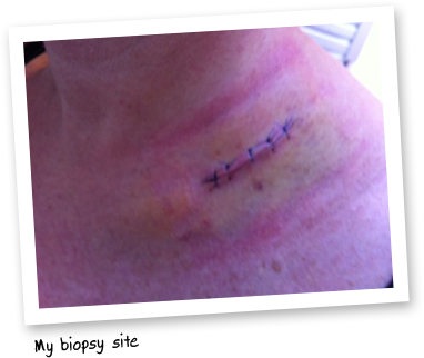 scar