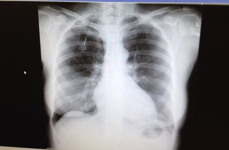 Chest xray with new sternum